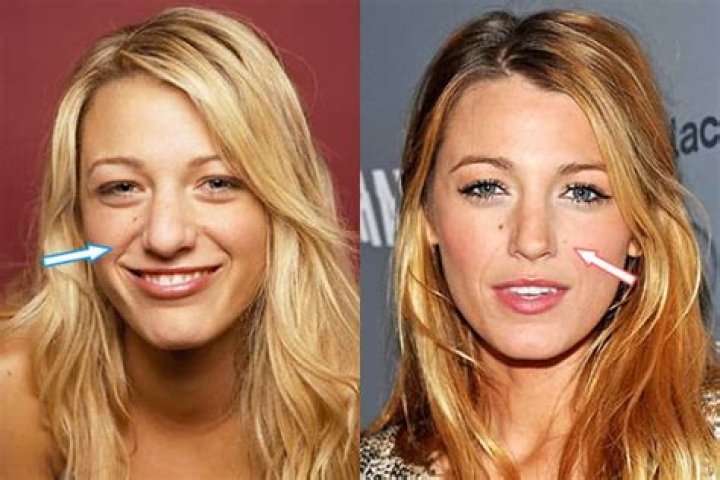 Blake Lively | Nose Job And Plastic Surgery Before And After