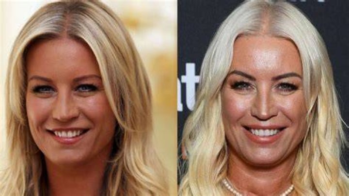 
Denise Van Outen Botox And Facelift Before And After Plastic Surgery 