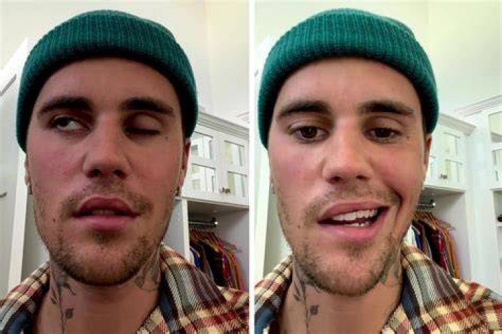 
Justin Bieber Has Facial Paralysis, Reveals Ramsay Hunt Syndrome Diagnosis in Video Message 